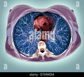 Brust Anatomie, 3D CT-scan Stockfoto