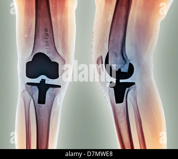 Knie-Totalprothese, Röntgenstrahlen Stockfoto