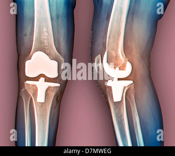 Knie-Totalprothese, Röntgenstrahlen Stockfoto