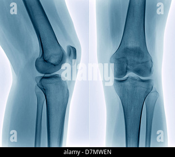 Gesunde Knie, x-ray Stockfoto