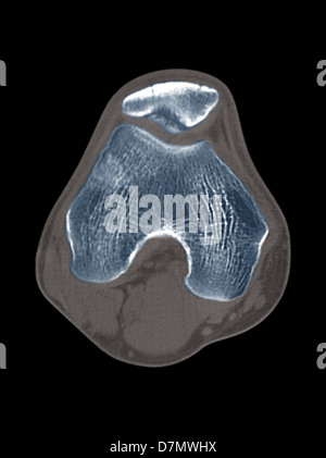 Knie Krankheit, CT-scan Stockfoto
