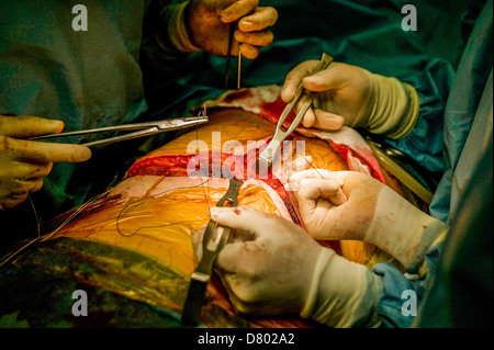 Chirurgen, die Durchführung einer Lebertransplantation. Stockfoto