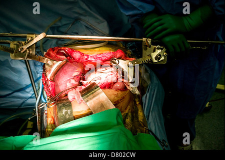 Chirurgen, die Durchführung einer Lebertransplantation. Stockfoto