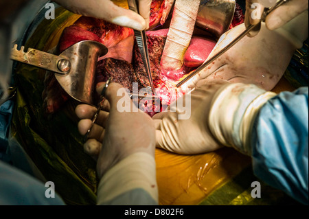 Chirurgen, die Durchführung einer Lebertransplantation. Stockfoto