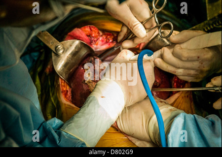 Chirurgen, die Durchführung einer Lebertransplantation. Stockfoto