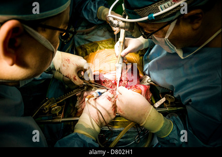 Chirurgen, die Durchführung einer Lebertransplantation. Stockfoto