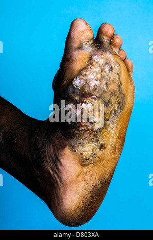Die Sohle des Fußes, ein junges Männchen leiden Myzetom angehören. Myzetom ist eine seltene Krankheit, die in den Tropen gefunden. Stockfoto