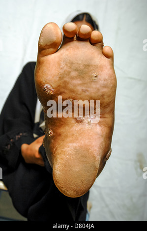 Nahaufnahme von Myzetom an der linken Fußsohle ein junges Weibchen. Stockfoto