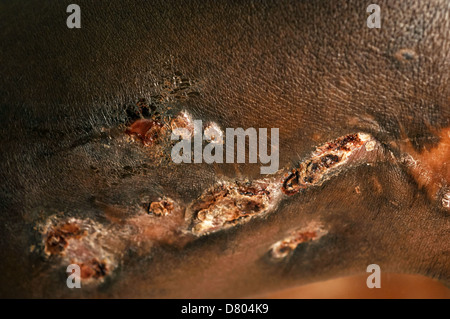 Myzetom auf das rechte Knie eines Patienten. Stockfoto