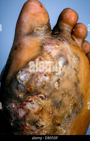 Die Sohle des Fußes ein junges Männchen leiden Myzetom. Stockfoto