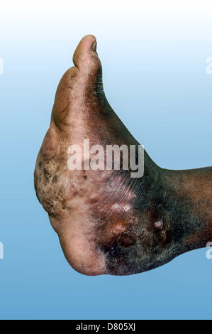 Myzetom auf dem linken Fuß eines jungen Mannes. Stockfoto