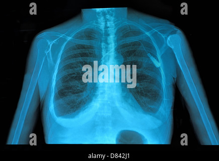 X-ray Image gesunde Brust Stockfoto