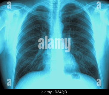 X-ray Image gesunde Brust Stockfoto