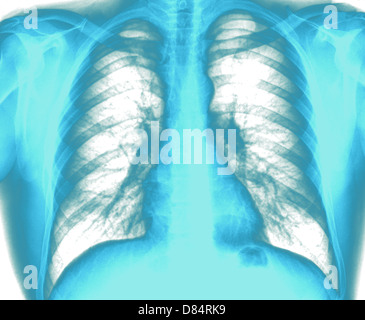 X-ray Image gesunde Brust Stockfoto