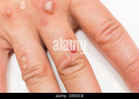 Hand des Mannes bedeckt mit Bläschen verursacht durch Kryochirurgie - Verfahren zum Entfernen Warze mit flüssigem Stickstoff Stockfoto