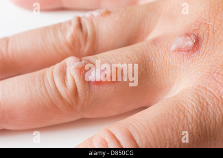 Hand des Mannes bedeckt mit Bläschen verursacht durch Kryochirurgie - Verfahren zum Entfernen Warze mit flüssigem Stickstoff Stockfoto