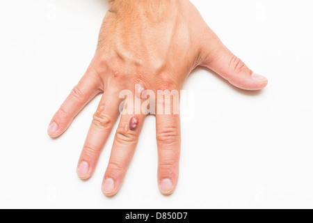 Hand des Mannes bedeckt mit Bläschen verursacht durch Kryochirurgie - Verfahren zum Entfernen Warze mit flüssigem Stickstoff Stockfoto