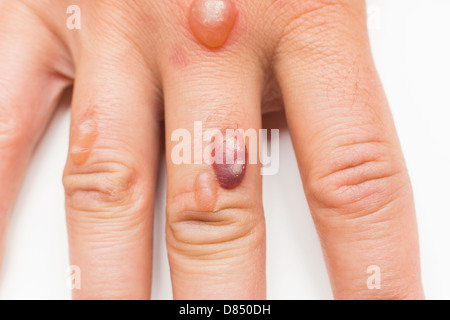 Hand des Mannes bedeckt mit Bläschen verursacht durch Kryochirurgie - Verfahren zum Entfernen Warze mit flüssigem Stickstoff Stockfoto