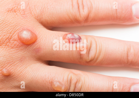 Hand des Mannes bedeckt mit Bläschen verursacht durch Kryochirurgie - Verfahren zum Entfernen Warze mit flüssigem Stickstoff Stockfoto