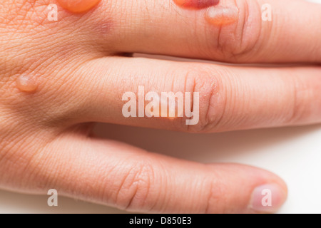 Hand des Mannes bedeckt mit Bläschen verursacht durch Kryochirurgie - Verfahren zum Entfernen Warze mit flüssigem Stickstoff Stockfoto