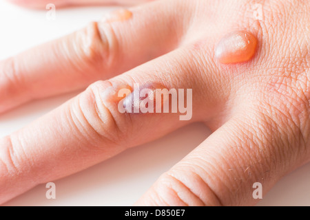 Hand des Mannes bedeckt mit Bläschen verursacht durch Kryochirurgie - Verfahren zum Entfernen Warze mit flüssigem Stickstoff Stockfoto