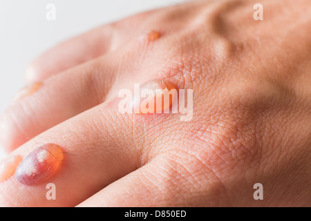 Hand des Mannes bedeckt mit Bläschen verursacht durch Kryochirurgie - Verfahren zum Entfernen Warze mit flüssigem Stickstoff Stockfoto