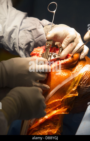 Knie-TEP Operation in einem Krankenhaus-Theater total Stockfoto