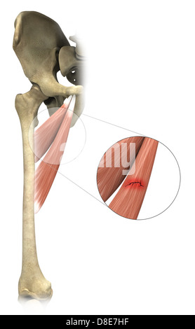 Beispiel für eine Adduktoren-Belastung Stockfoto
