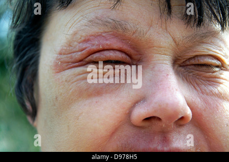 Frau leidet mit Ekzemen & einen Ausschlag für die meisten des Gesichtes mit dem Muskelkater umgebenden & Auswirkungen auf die Augen Stockfoto