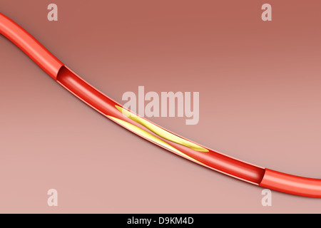 Arteriosklerose. Plaketten, die Verschärfung einer Arterie. 3D gerenderte Darstellung. Stockfoto