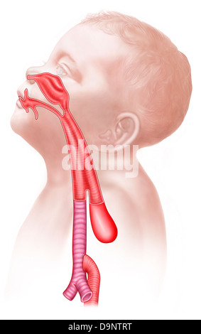 Anatomie einer tracheoesophageal Fistel. Stockfoto