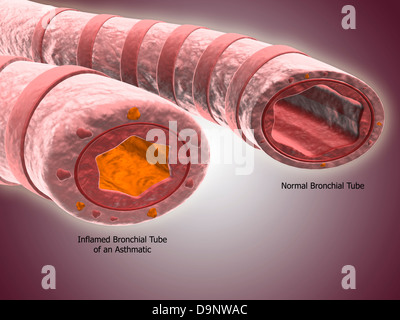 Luftröhre Querschnitt zeigt Vergleich von normalen und asthmatischen Bronchialsystem. Stockfoto