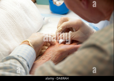 Der Dupuytren'schen Kontraktur Behandlung des kleinen Fingers auf eine Frau Hand Arzt mit Nadel, die Finger zu behandeln Stockfoto