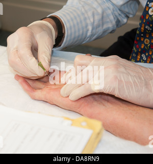Der Dupuytren'schen Kontraktur Behandlung des kleinen Fingers auf eine Frau Hand Arzt mit Nadel, die Finger zu behandeln Stockfoto