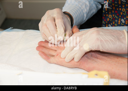 Der Dupuytren'schen Kontraktur Behandlung des kleinen Fingers auf eine Frau Hand Arzt mit Nadel, die Finger zu behandeln Stockfoto