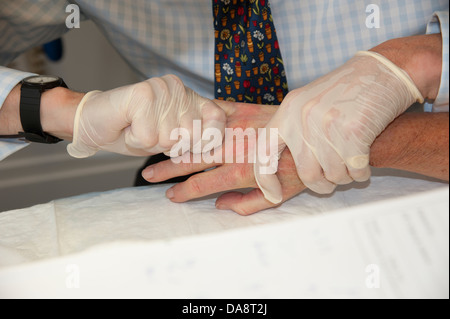 Der Dupuytren'schen Kontraktur Behandlung des kleinen Fingers auf eine Frau Hand Arzt Bearbeiten von Hand Verfahren Stockfoto
