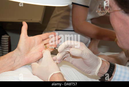 Der Dupuytren'schen Kontraktur Behandlung des kleinen Fingers auf die Hand einer Frau Doktor Injektion Steroid-Injektion Stockfoto