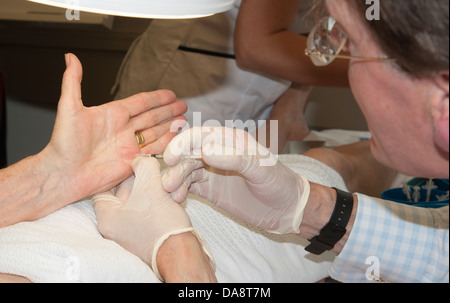 Der Dupuytren'schen Kontraktur Behandlung des kleinen Fingers auf die Hand einer Frau Doktor Injektion Steroid-Injektion Stockfoto