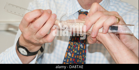 Der Dupuytren'schen Kontraktur Behandlung des kleinen Fingers auf eine Frau Hand Arzt Messung des gebeugten Fingers Stockfoto
