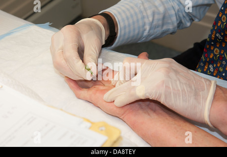 Der Dupuytren'schen Kontraktur Behandlung des kleinen Fingers auf eine Frau Hand Arzt mit Nadel, die Finger zu behandeln Stockfoto