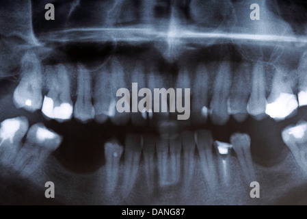 Panorama-Röntgenaufnahme Bild scannen von Menschen Zähne Stockfoto