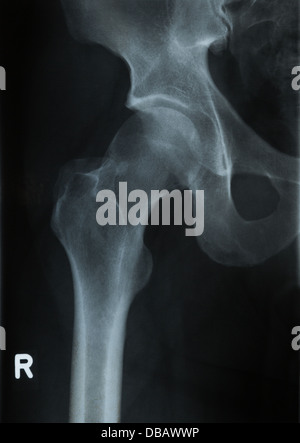 Radiologie-Röntgenaufnahme der menschlichen Hüfte Stockfoto