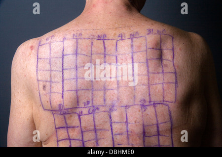 Rücken des Patienten eine Frau wird mit Angabe der Standorte für die Patches einer Chemotechnique Allergan Reihe Quadrate gezeichnet. Stockfoto