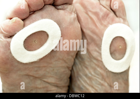 Ältere Frau mit spezialisierten Mais Putze die Füße, um Druck zu entlasten, wenn Sie gehen Stockfoto