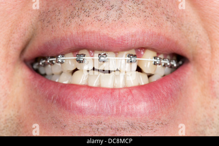 Nahaufnahme von geschweiften Klammern an den Zähnen des Oberkiefers mit unrasierten Männern Stockfoto