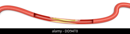 Arteriosklerose. Plaketten, die Verschärfung einer Arterie. 3D gerendert Illsutration. Isoliert auf weiss. Stockfoto