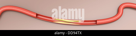 Arteriosklerose. Plaketten, die Verschärfung einer Arterie. 3D gerenderte Darstellung. Stockfoto