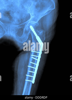 Hip Xray Bild medizinischen Hintergrund Stockfoto