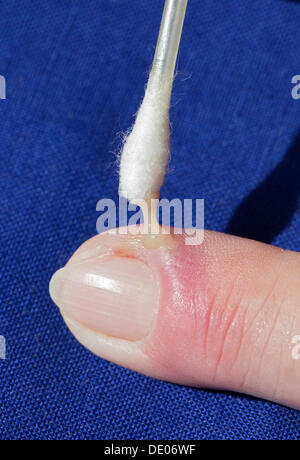 Bakterielle Infektion, Entzündung, Zeigefinger, Eiter, Abszess