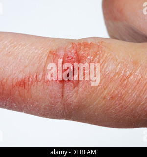 Mans Zeigefinger mit einem frischen Schnitt. Stockfoto